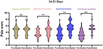 The impact of SARS-Cov-2 infection on the periocular injection pain and hypersensitive reaction to botulinum toxin type A: results from clinical questionnaires